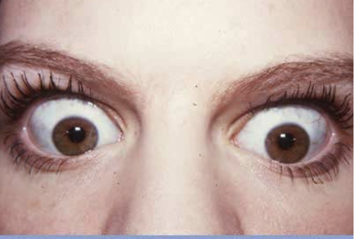 <p>Grave's disease (hyperthyroidism) is an example of thyroid _________</p>