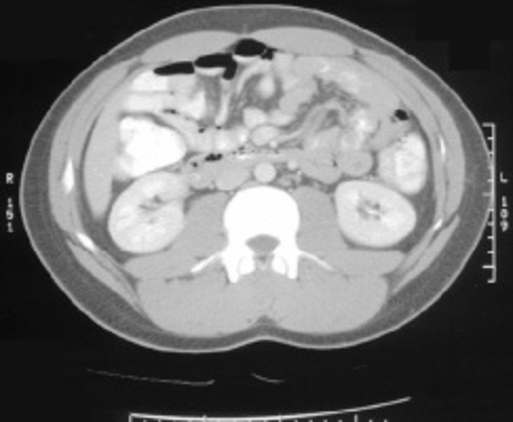 <p>CT scan- usually w/ IV/GI (oral) contrast</p><p>fast and detailed exam of abdomen and pelvis</p>