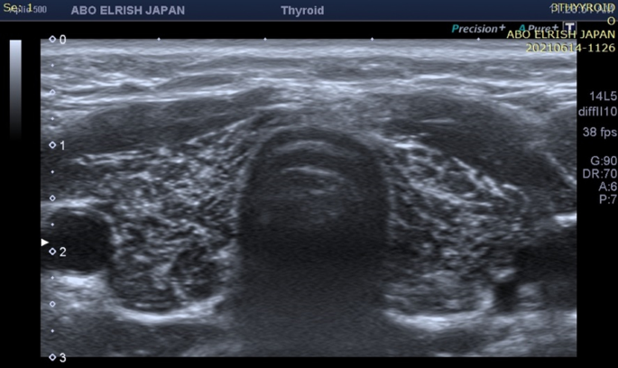 what thyroid pathology is shown here?

young middle-aged woman; painless, diffusely enlarged thyroid; low serum T3/T4 and elevated TSH