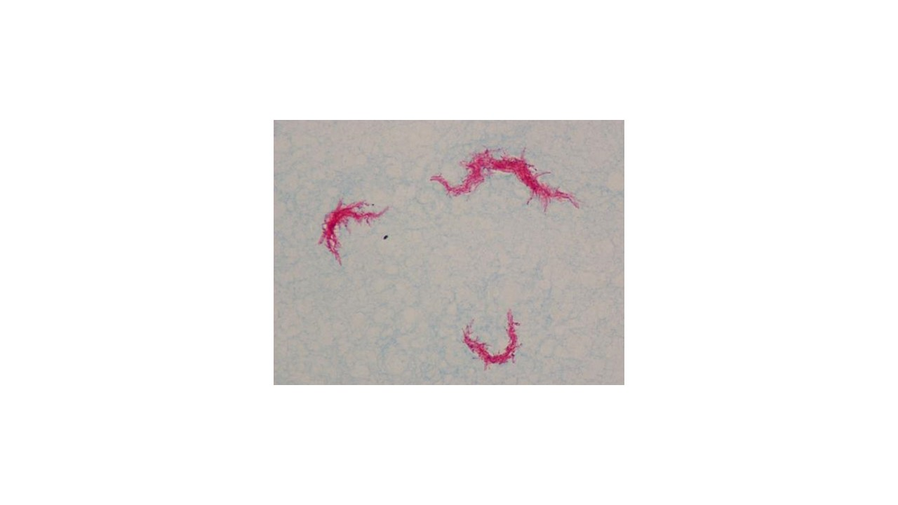 <p>l<span>ooking at the micrograph, does the bacteria Mycobacterium tuberculosis produce the waxy material in its cell wall</span></p>