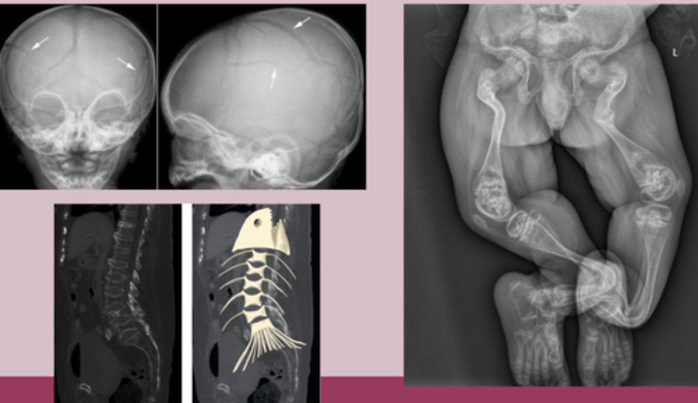<p>-clinical </p><p>Labs </p><p>-usually normal </p><p>-genetic testing = confirmatory </p><p>Imaging </p><p>-Xray: generalized osteopenia, multiple fractures, thin cortices, bowing deformities, codfish vertebrae </p><p>-DEXA scan: show decreased BMD </p>