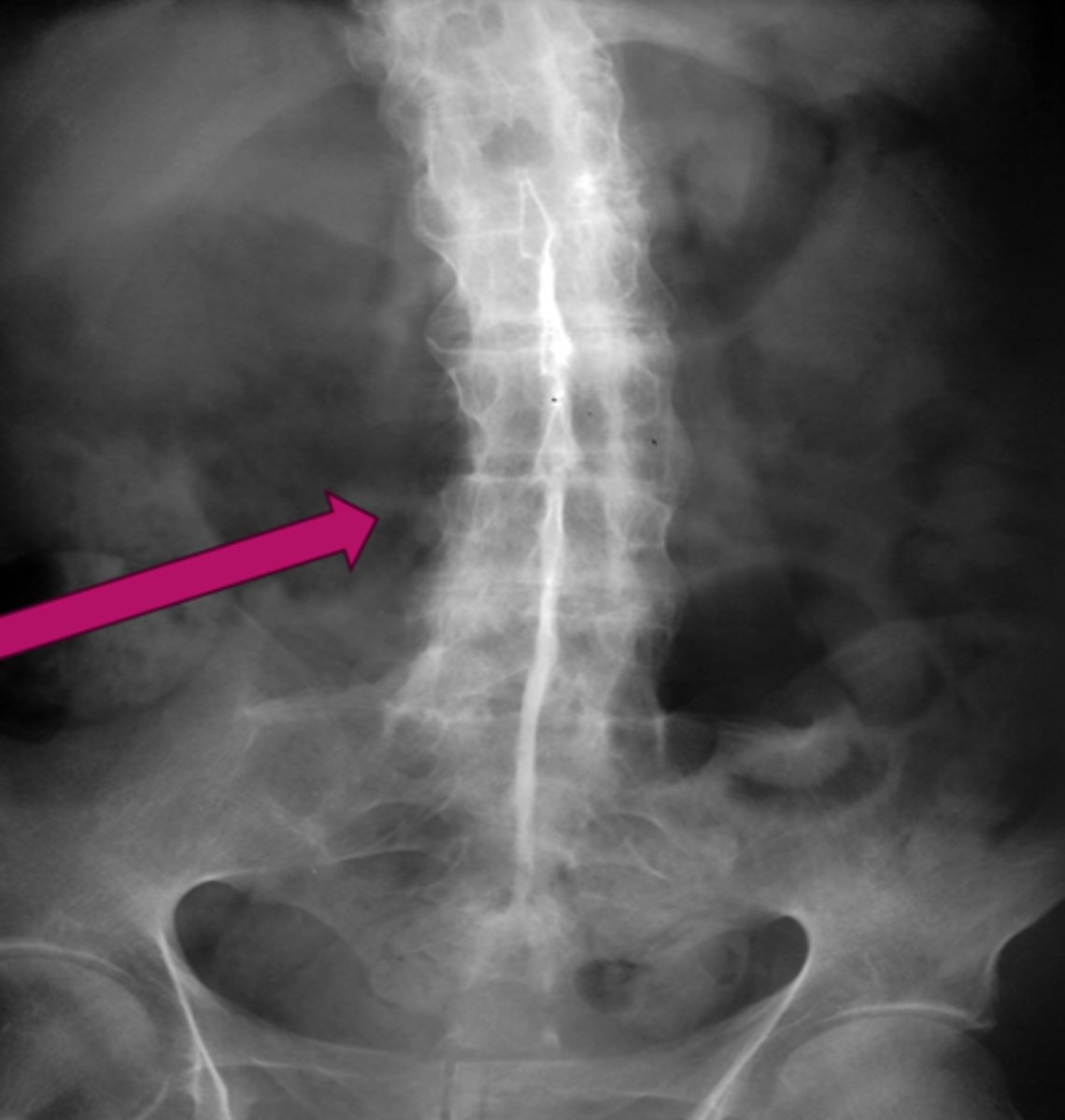 <p>What pathology is seen here?</p>