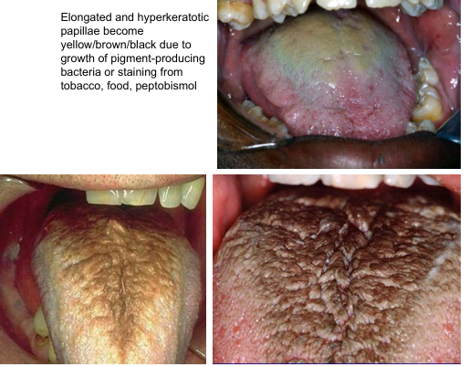<p>-keratin accumulation on dorsal tongue (filiform papillae)- either increased keratin production or decrease in normal desquamation of keratin → hair-like appearance</p><p>-may produce gagging sensation or bad taste</p><p>-coated tongue- same but no hair-like projections- may also cause oral malodor</p>