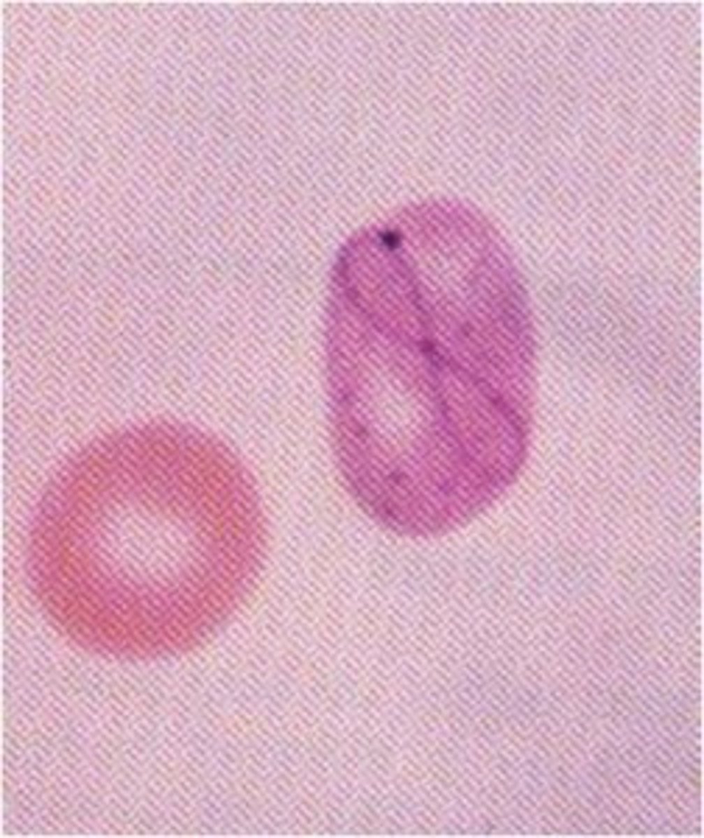 <p>- chemo and myelodyplastic syndrome</p>