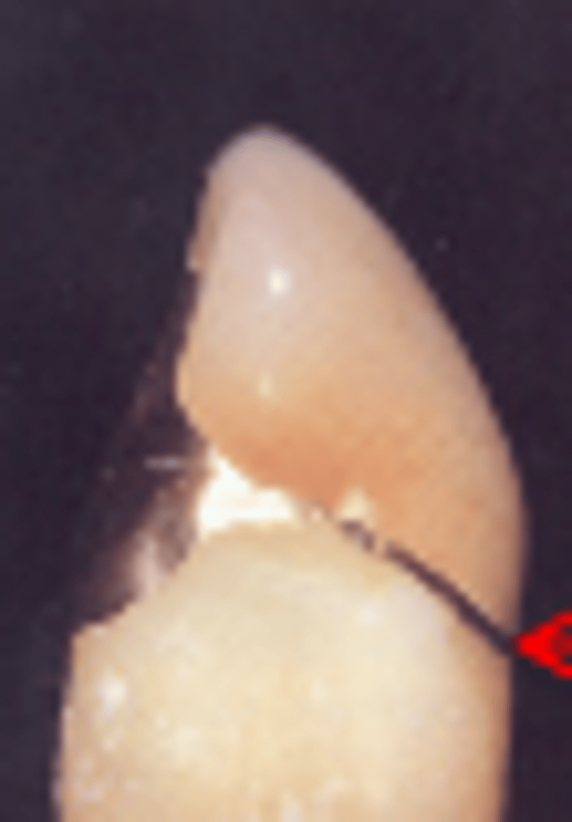 <p>Any type of finish line, especially on beveled shoulder or beveled deep chamfer</p>