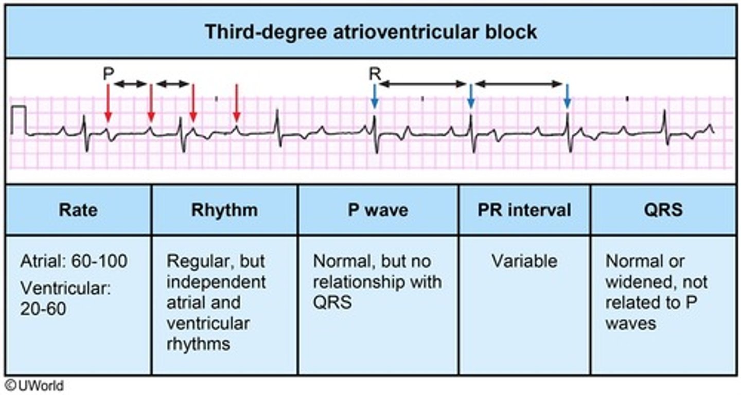 <p>no atrial impulse is conducted through the AV node into the ventricles</p><p>two separate impulses are happening at the same time</p>