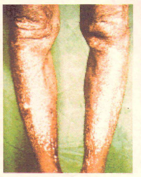 <p>Disease; caused by?</p>