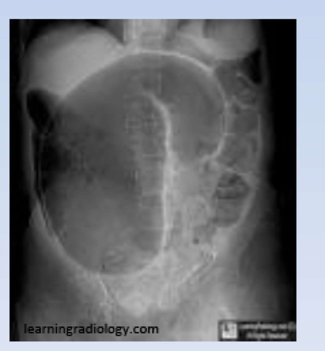 <p>dilated sigmoid colon, air and stool in more proximal descending colon</p><p>can lead to strangulation (vascular compromise leading to infarction of bowel wall)</p>