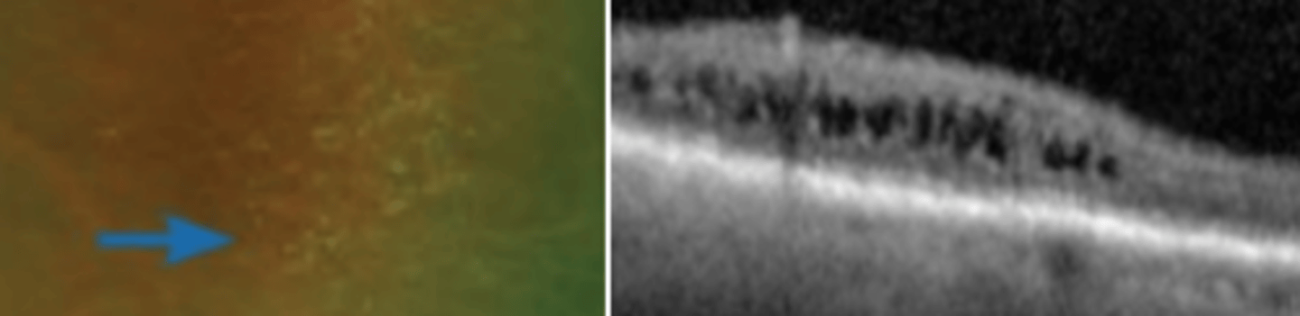 <p>the most common** intra-retinal degeneration involving cystoid like changes of the INL/OPL which can extend to the sensory retina. Is generally benign, but can cause splitting of the sensory retina (retinoschisis) if they coalesce to form large cystic spaces. Potential for retinal hole and detachment.</p>