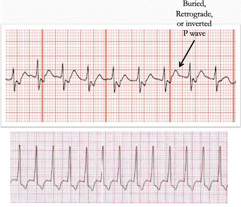 <ul><li><p class=""><strong>Rate</strong>: <u>Atrial</u> — <mark data-color="yellow" style="background-color: yellow; color: inherit">70 to 120 bpm</mark> (if P waves are discernible); <u>Ventricular</u> — <mark data-color="yellow" style="background-color: yellow; color: inherit">70 to 120 bpm</mark></p></li></ul><ul><li><p class=""><strong>Rhythm</strong>: Regular</p></li><li><p class=""><strong>P Waves</strong>: May be absent, after the QRS, or before the QRS; may be inverted</p></li><li><p class=""><strong>P to QRS Ratio</strong>: 1:1 or 0:1</p></li><li><p class=""><strong>PR Interval</strong>: If the P wave is in front of the QRS, the PR interval is less than 0.12 seconds</p></li><li><p class=""><strong>QRS Complex</strong>: Usually normal, may be widened</p></li></ul><p></p>
