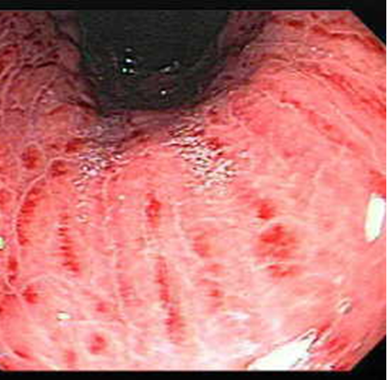 <p>What condition?</p><ul><li><p>upper endo findings: sub epithelial hemorrhages, petechiae, erosions</p></li><li><p>sx: anorexia, epigastric pain, N, V</p></li><li><p>UGI bleeding- hematemesis: “coffee ground” emesis, bloody aspirate w/ NG suction, usually insignificant amounts, possibly melena</p></li></ul><p></p>