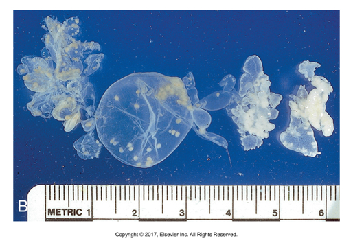 <ul><li><p>Forms coenurus that is found in sheep or rabbit intermediate host​</p></li><li><p>Coenurus cerebralis (M. multiceps) or Coenurus serialis (M. serialis)​</p></li><li><p>Single large bladder with several scolices attached to the wall​</p></li><li><p>Unique in that many tapeworms mature from each coenurus, one for each scolex​</p></li><li><p>In sheep, hexacanth embryos are ingested and larvae (5cm) migrate to nervous system (brain or spinal cord) and can produce neurological symptoms in infected sheep​</p></li><li><p>Dogs infected by ingesting sheep parts​</p></li><li><p>In rabbits, hexacanth embryos are ingested in dog feces, hatch and migrate into subcutaneous tissues which can interfere with movement, slow rabbits more likely to be caught and eaten by dogs</p></li></ul><p></p>