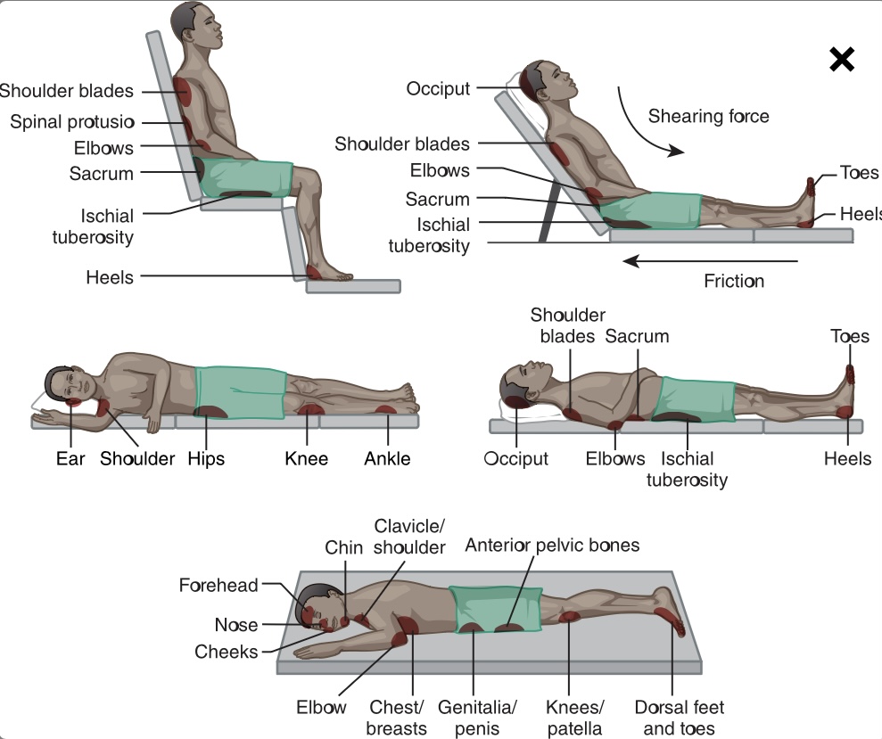 Bony prominences 

\-heels, toes, sacrum, hips, elbows, shoulders, and back of the head 