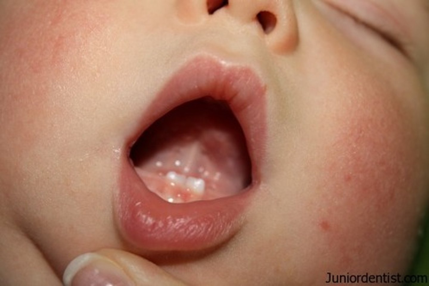 <p>Yes, and the cause is unknown. They may be small, discolored, loose, and often not fully developed.</p>