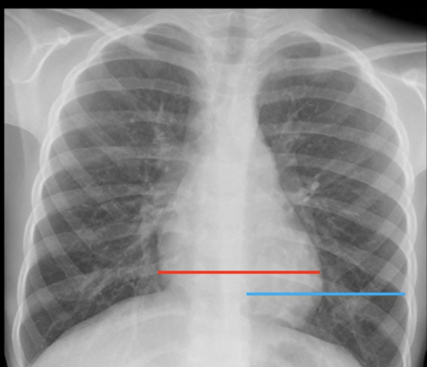 <p>(evaluating AP CXR) normal size of cardiac silhouette?</p>
