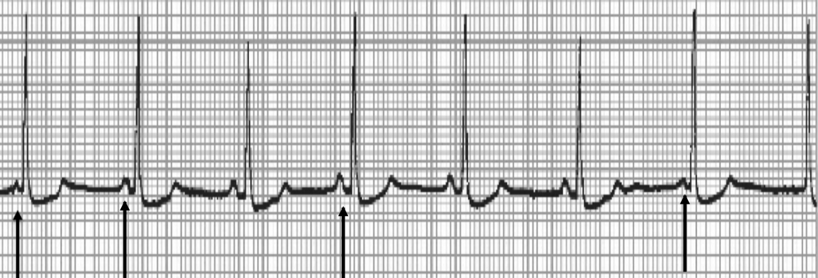 <p>Multifocal atrial tachycardia and wandering atrial pacemaker (WAP)</p>