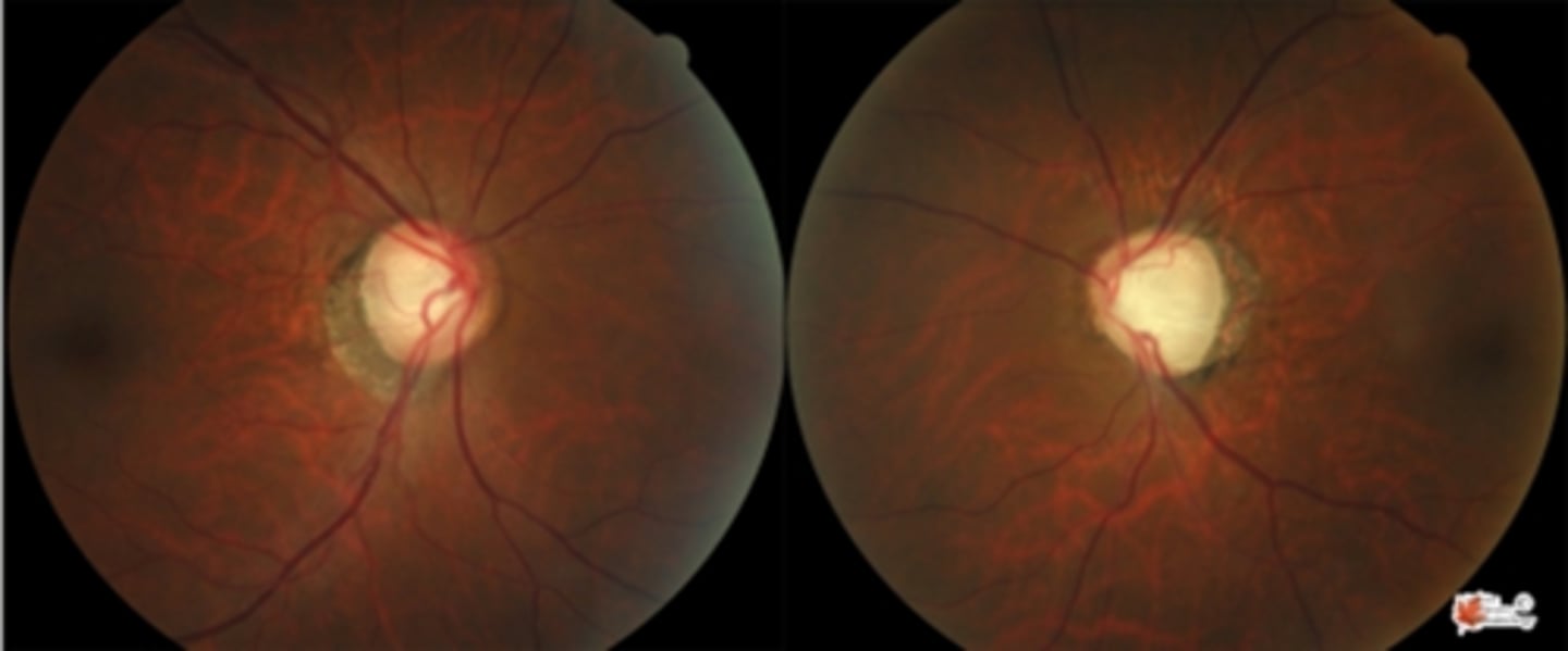 <p>ischemia = e.g. ischemic optic neuropathy</p><p>compression = e.g. a tumor pushing on the chiasm</p><p>inflam = e.g. demyelinating disease</p><p>trauma = e.g. traumatic optic neuropathy after getting hit in the eye</p>