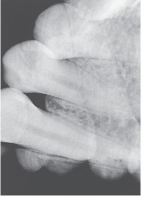 <p>What is the problem with this Double Image/Dual Exposure X-ray?</p>