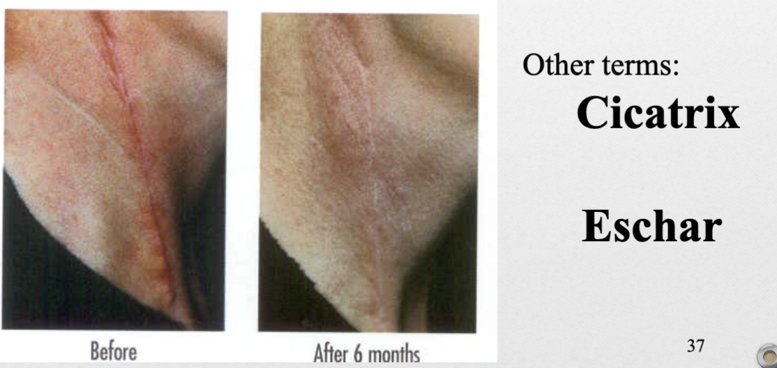 <p>ex. cicatrix, eschar</p>