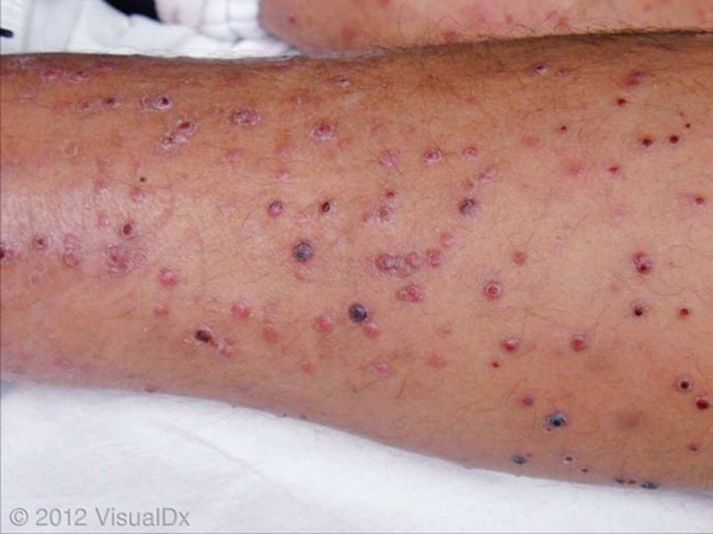 <p>-bartonella endemic to the andes mountains</p><p>-transmitted by female sand fly</p><p>-most frequently in children</p>