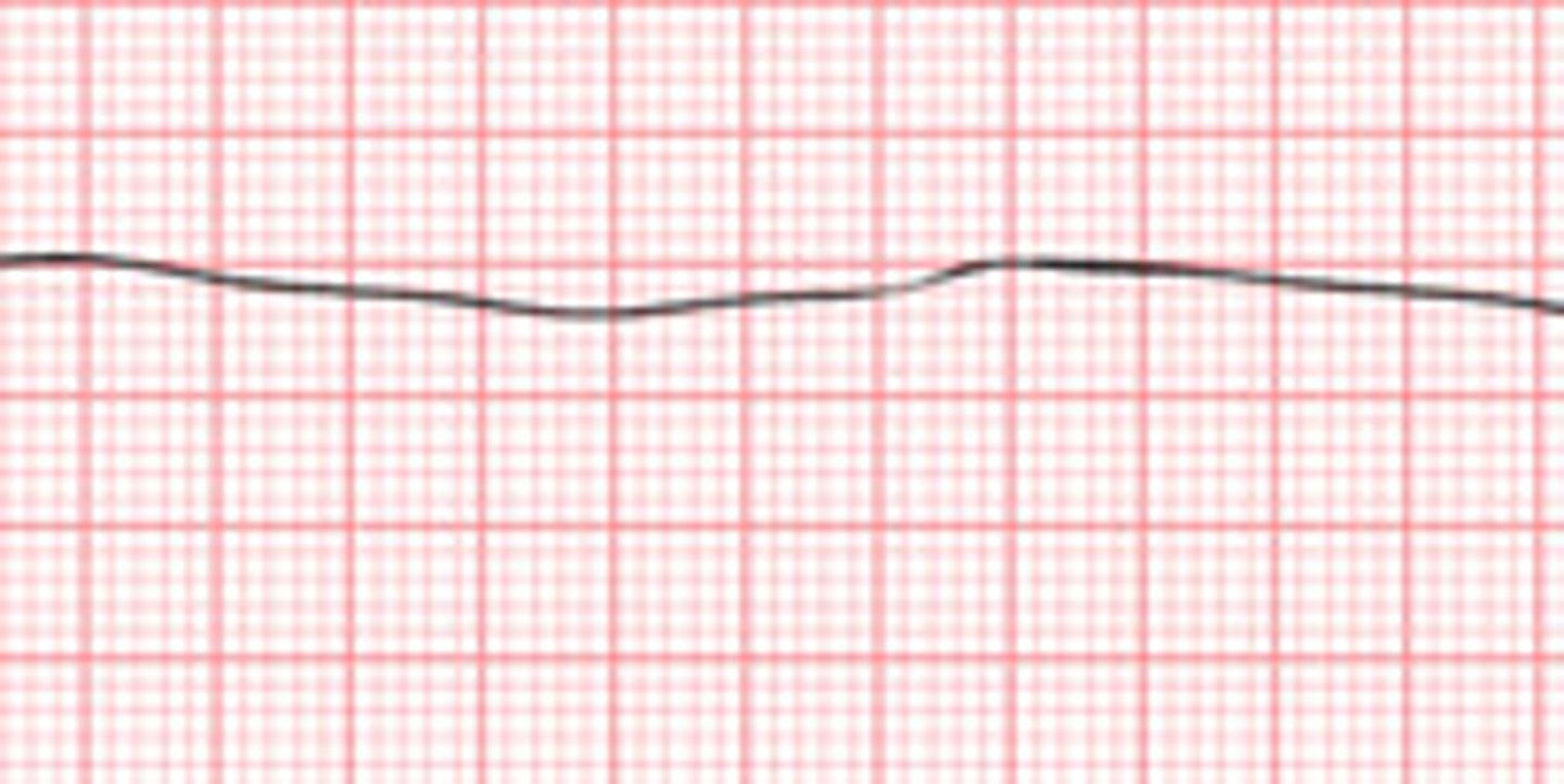 <p>Asystole is like a flat line on a heart monitor, and the priority nursing action is to assess the patient because in asystole there is no electrical activity, so CPR is needed.</p>
