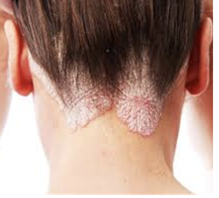 <p><span>How would you document this skin lesion?</span></p><p></p>