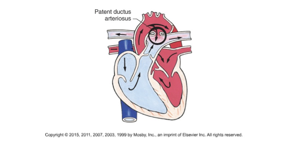 <p>a normal fetal artery connecting the main body artery (aorta) and the main lung artery (pulmonary artery) to direct blood away from lungs</p><p>should close by 15 hours after birth</p><p> </p>