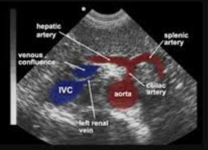 <p>Branches into 3 Vessels</p><p>– Common Hepatic Artery</p><p>– Splenic Artery</p><p>– Left Gastric Artery</p><p>• Typically only Common Hepatic Artery and Splenic Artery visualized on ultrasound </p>