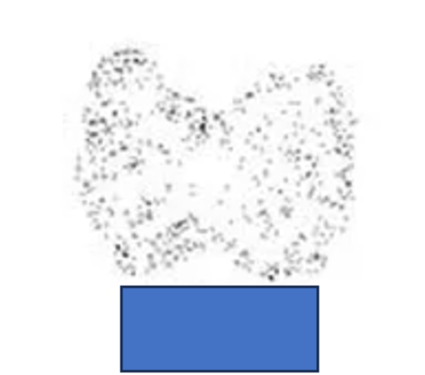 <p>Define Cause of Hyperthyroidism:</p><p>Autoimmune injury to gland impairs ability to produce TH --&gt; TRANSIENT Phase (destruction of gland --&gt; "Leak" preformed TH) for 4-8 wks</p><p>-Sx:</p><p>&gt; Tremors</p><p>&gt; Palpitations</p><p>&gt; Anxiety</p><p>&gt; Diarrhea</p><p>&gt; Heat Intolerance</p><p>&gt; Wt Loss</p><p>&gt; Fatigue</p><p>-PE:</p><p>&gt; Tachycardia</p><p>&gt; Systolic HTN w/ widened pulse pressure</p><p>&gt;&gt; High SBP d/t increased cardiac output</p><p>&gt;&gt; Low DBP d/t less PVR</p><p>&gt; Wt Loss</p><p>&gt; Eyelid Lag (abnormally raised upper eyelid d/t SNS hyperactivity --&gt; still see sclera when they look down)</p><p>&gt; Thyroid gland slightly enlarged/firm (NONTENDER)</p><p>-Dx: </p><p>Labs</p><p>&gt; Key Findings</p><p>&gt;&gt; TPO (Thyroid Peroxidase) Ab - aka antimicrosomal Ab</p><p>&gt;&gt; TG (Thyroglobulin) Ab</p><p>&gt; TSH = Low</p><p>&gt; Free T4 = High</p><p>Radioactive Iodine Uptake Scan</p><p>&gt; Low = NOT making new TH</p><p>-Tx:</p><p>&gt; Beta Blocker = Sx Relief during Phase</p>