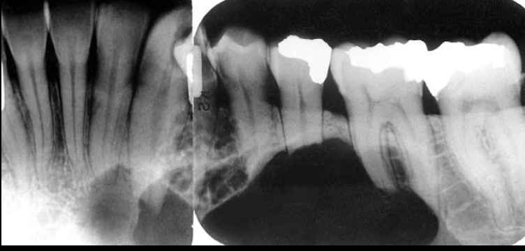 <p>Ameloblastoma</p>