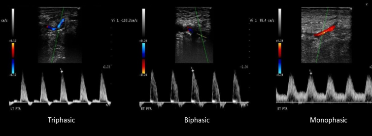 <p>When flow during systole is antegrade and some flow is reversed during diastole </p>