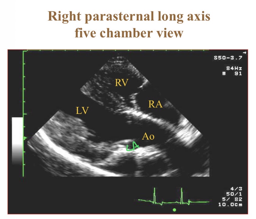 <p>RV, LV, LA, RA, aorta </p>