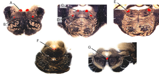 <p>PI: a unilateral lesion of which of the following results in sagging of ipsilateral palatal arch and vocal muscle paralysis?</p>