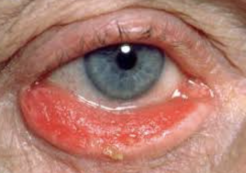 <p>Abnormal Findings in <strong><em>4. Position of the eyelids in comparison with the eyeballs</em></strong></p><ul><li><p>Everted lower eyelid</p></li><li><p>Results in exposure and drying of the conjunctiva</p></li></ul><p></p>