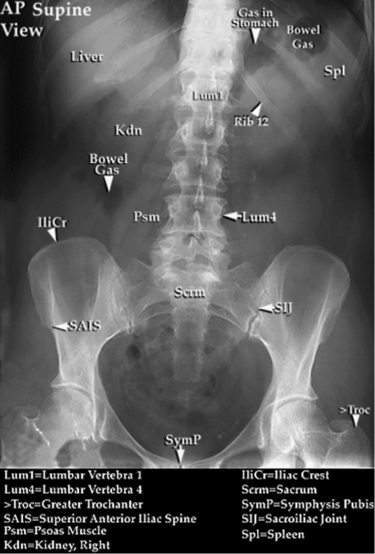 <p>kidneys, ureters, and bladder aka flat plate</p>