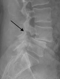 <p>spondylolisthesis</p><p>bilateral pars interarticularis fracture at the L4/L5 level</p><p>disc has slipped posteriorly</p><p>stretches/displaces the anterior longitudinal ligament due to posterior translation in the anterior column</p>