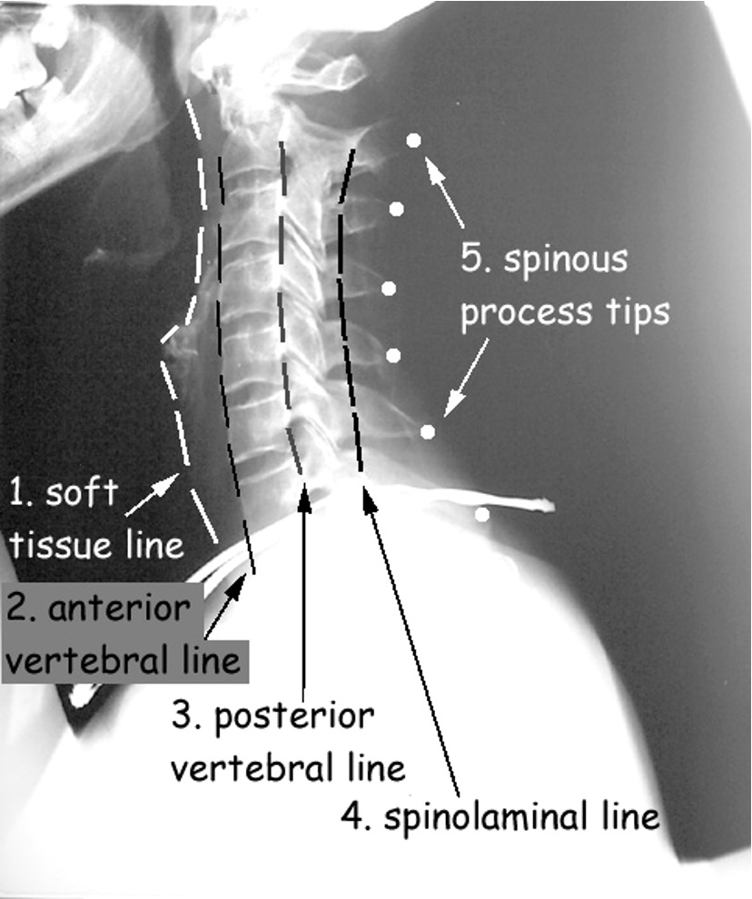 <p>anterior soft tissue line</p><p>arterial spinal/vertebral line</p><p>posterior spinal/vertebral line</p><p>spinolaminal line</p><p>spinous process line</p>