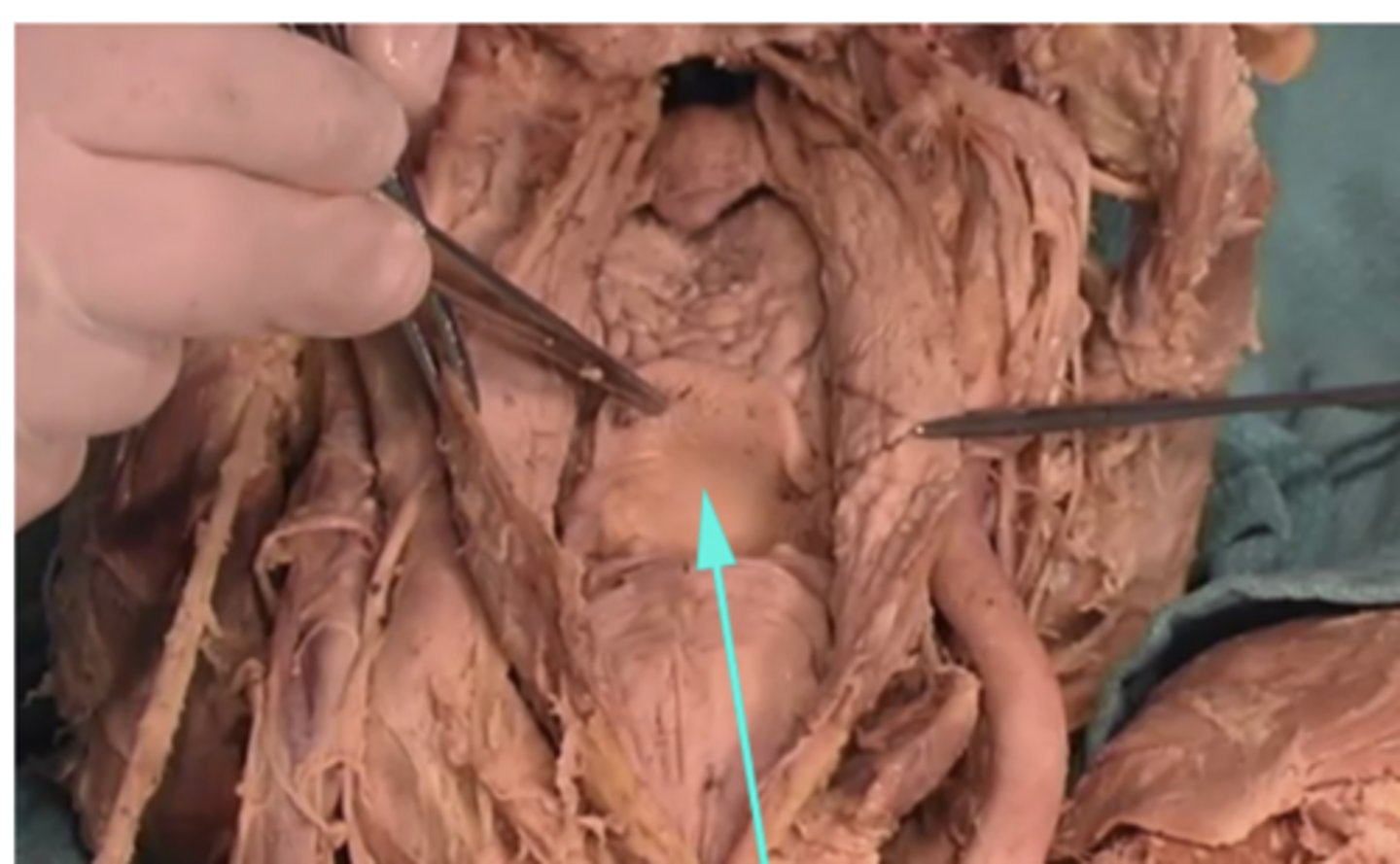 <p>What is the name of the structure as indicated by the arrow?</p><p>-Dorsum of the tongue</p><p>-Superior phrenic artery</p><p>-Epiglottis</p><p>-Tongue</p>