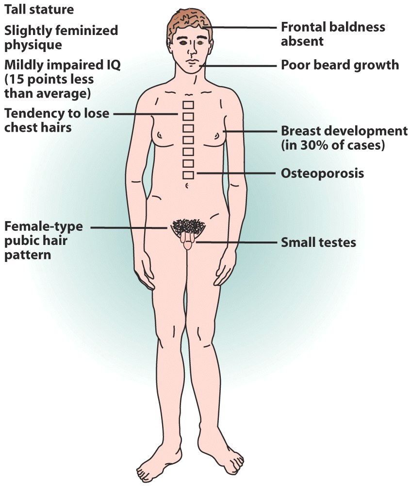 <ul><li><p>In male, Sex chromosomes have additional chromosome (XXY)</p></li><li><p>Secondary sexual characteristics from more estrogen</p></li><li><p>Characterized with long arms and legs, wider hips, narrower shoulders, breast tissue growth</p></li></ul>