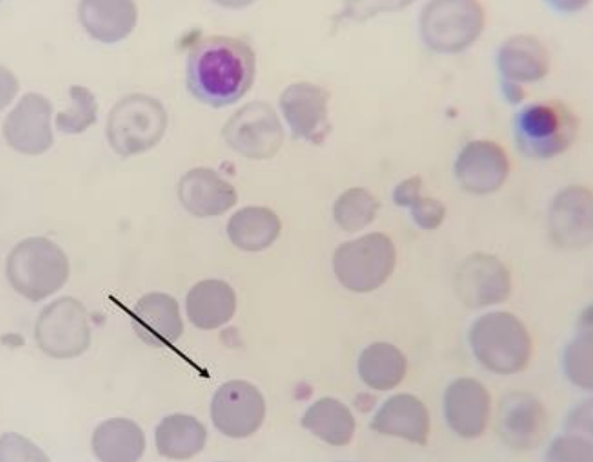 <p>what disease/condition is associated with nRBCs, H-J bodies, and polychromasia?</p>
