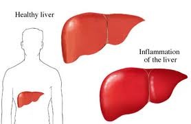 Hepatitis A