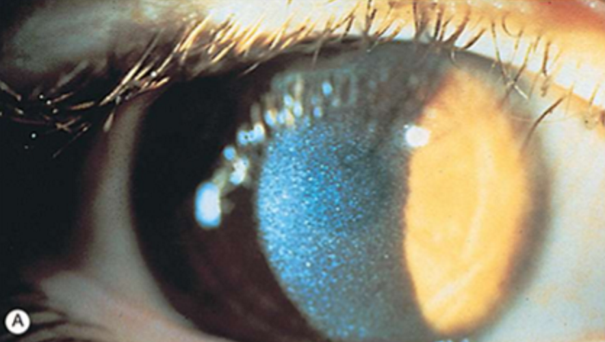 <p>How do we treat cystinosis?</p>