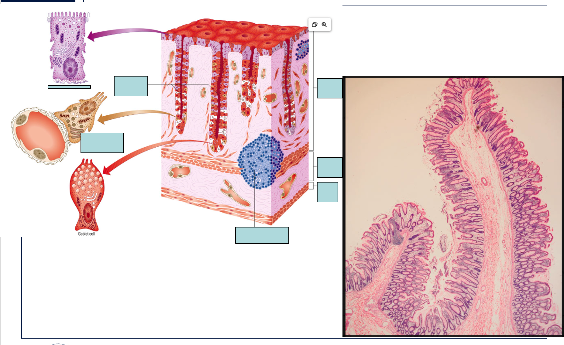 <p><strong>About the Diagram (Left Panel):</strong></p><ol><li><p>What are the main layers of the intestinal wall shown in the diagram?</p></li><li><p>What specific structures are found within the Mucosa layer?</p></li><li><p>What are the characteristic invaginations of the intestinal lining called?</p></li><li><p>Identify the different cell types depicted in the intestinal glands.</p></li><li><p>What is the primary function of the "Columnar absorptive cell" in this region?</p></li><li><p>What is the primary function of the "Goblet cell" and what does it secrete?</p></li><li><p>Where are "Neuroendocrine cells" located and what is their general role?</p></li><li><p>What is the significance of the "Lymphoid follicle" in the submucosa?</p></li><li><p>What is the role of the "Part of muscularis externa" shown in the diagram?</p></li><li><p>How does the arrangement of cells in the intestinal glands differ from the surface epithelium?</p></li></ol><p><strong>About the Microscopic Image (Right Panel):</strong></p><ol start="11"><li><p>What anatomical structure is likely represented in the microscopic image? (Hint: based on the features shown).</p></li><li><p>Can you identify the crypts (intestinal glands) in the microscopic image?</p></li><li><p>What is the prominent cell type visible lining the crypts and surface, and what features help identify it?</p></li><li><p>What are the clear, vacuolated cells often seen in abundance in this tissue, and what do they represent?</p></li><li><p>How does the microscopic image correlate with the structural features shown in the diagram?</p></li></ol><p><strong>Comparative/Integrative Questions:</strong></p><ol start="16"><li><p>How does the histology of this region (colon) differ from that of the small intestine (e.g., presence/absence of villi, abundance of goblet cells)?</p></li><li><p>What are the key adaptations of this intestinal region for its specific digestive/absorptive functions, as suggested by its histology?</p></li><li><p>How do the various cell types shown contribute to the overall function of the large intestine?</p></li></ol><p></p>