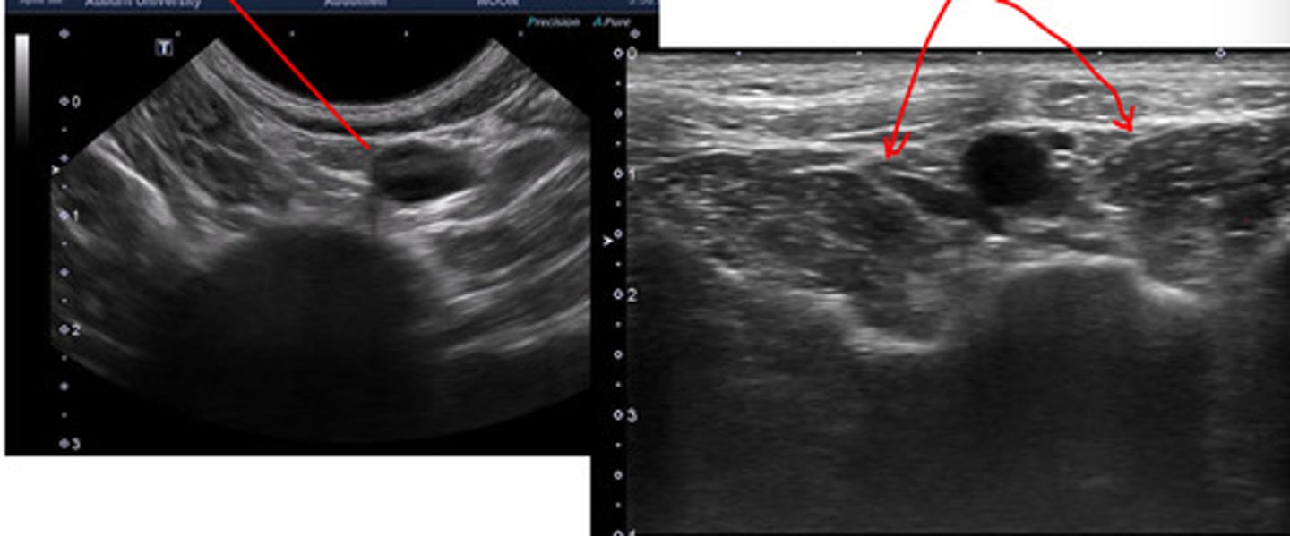 <p>ID lymph node (hint: trifurcation near)</p>