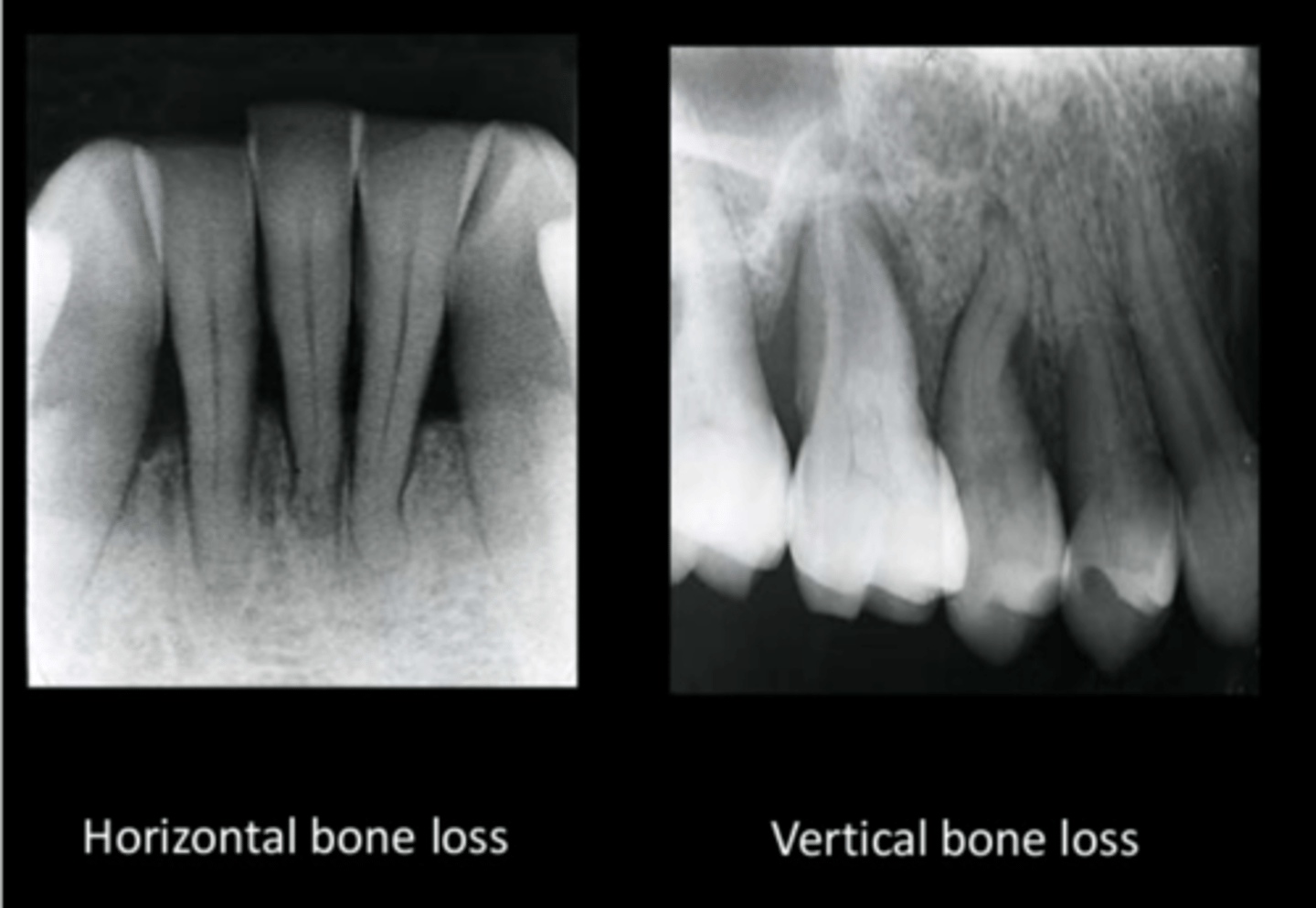 <p>Initial bone changes shows crest of bone as fuzzy, not a definite shape</p><p>vertical bone loss</p><p>horizontal bone loss</p>