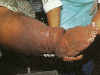 <p>(parasitology)</p><ul><li><p><span style="font-family: &quot;DM Sans&quot;, sans-serif">caused by parasitic roundworms: <strong>wuchereria bancrofti and brugia malayi</strong></span></p></li></ul><p></p>