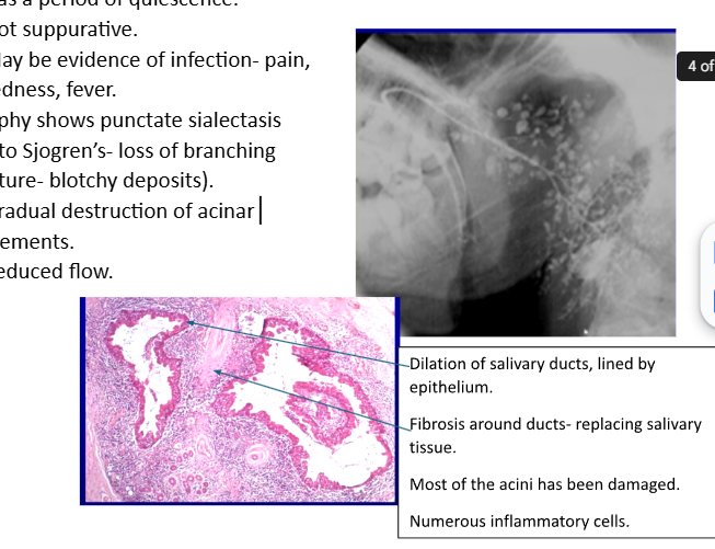 <p><span style="background-color: transparent;">Punctate sialectasis → blotchy deposits (like Sjogren’s - loss of branching architecture)</span></p><p>Gradual destruction of acinar elements and reduced flow</p><p>Histology:</p><p>Dilation of salivary ducts with fibrosis around duct (salivary tissue replaced</p><p>Reduced salivary ducts where acini damaged</p><p>Inflammation (;lymphocytes) extending into ducts</p>