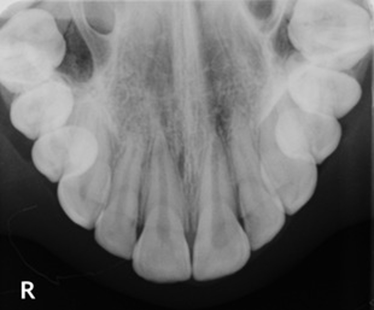 <p>image that shows large areas of the maxilla or mandible</p>