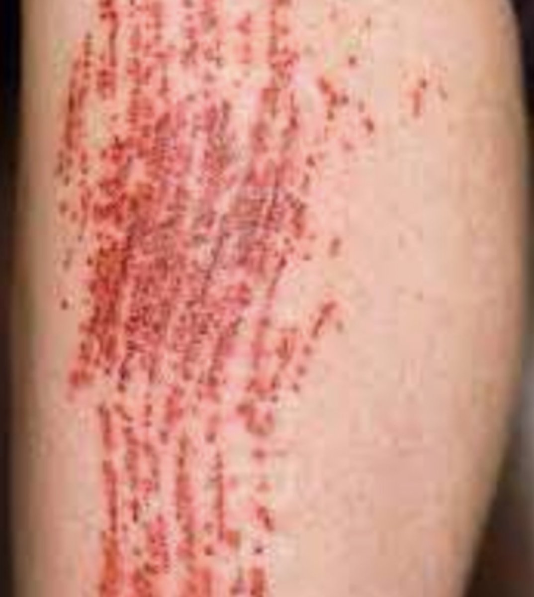 <p>¿lesión?</p><p>¿primaria o secundaria?</p>