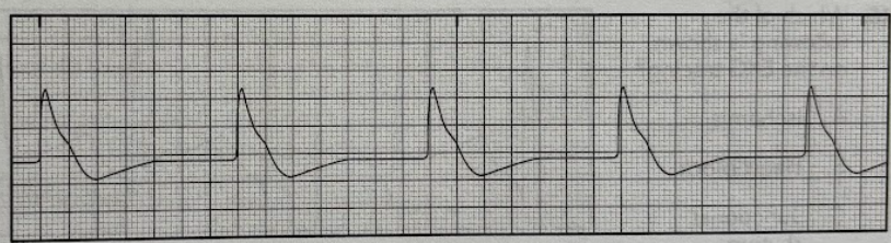 <p>Using the EKG tracing, identify the arrhythmia.</p><p>A. Sinus</p><p>B. Atrial</p><p>C. Ventricular</p><p>D. Junctional</p>